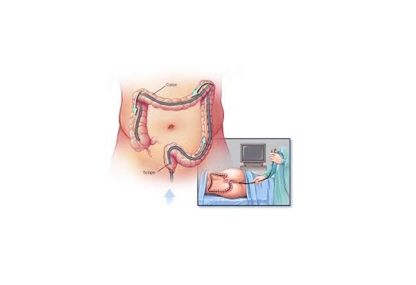 Colonoscopy: Risks and Side Effects of the Procedure