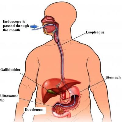 Endoscopic Ultrasound